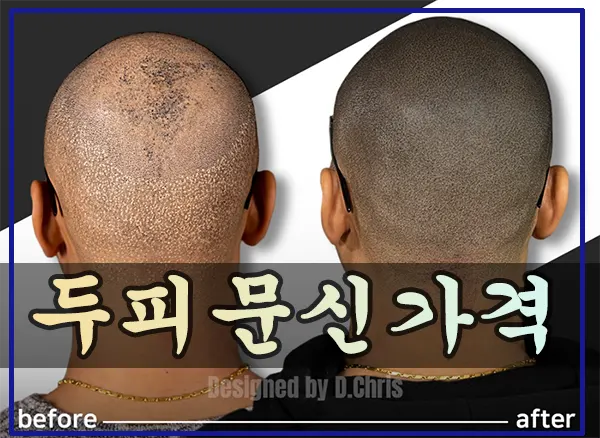 두피문신 가격 두피문신 가격